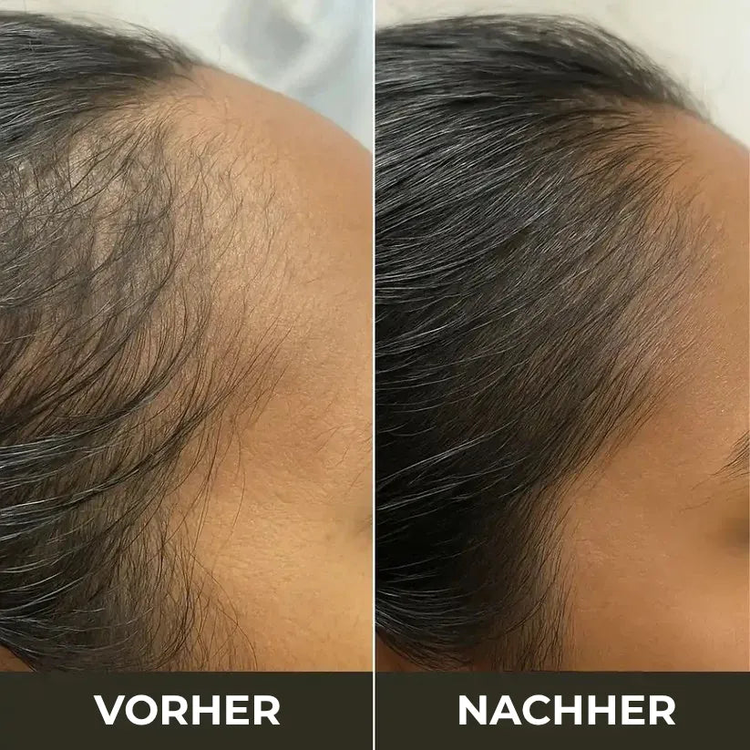 Anti-Haarausfall Kit: TheraBrush™ & Rosmarinöl